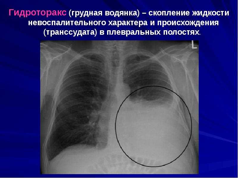 Сердечная недостаточность