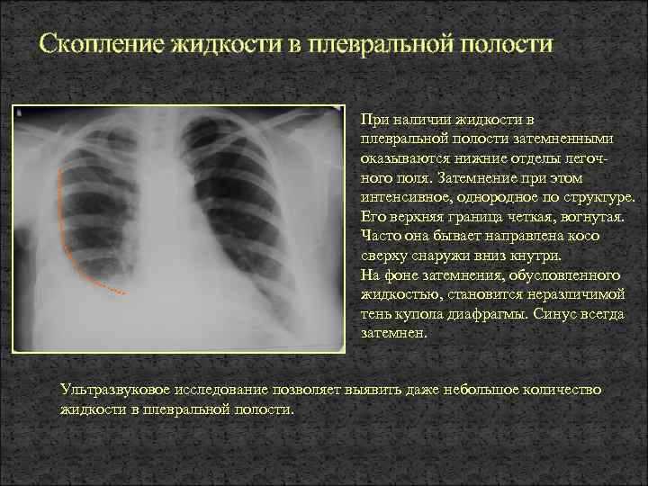 Травмы грудной клетки