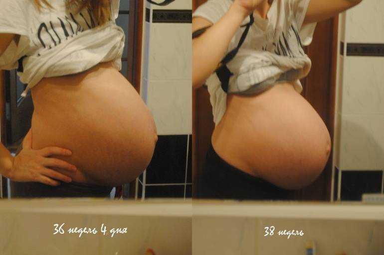 Причины опускания живота у беременных