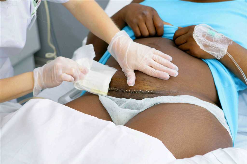 Важность ведения беременности и родов после кесарево специалистами