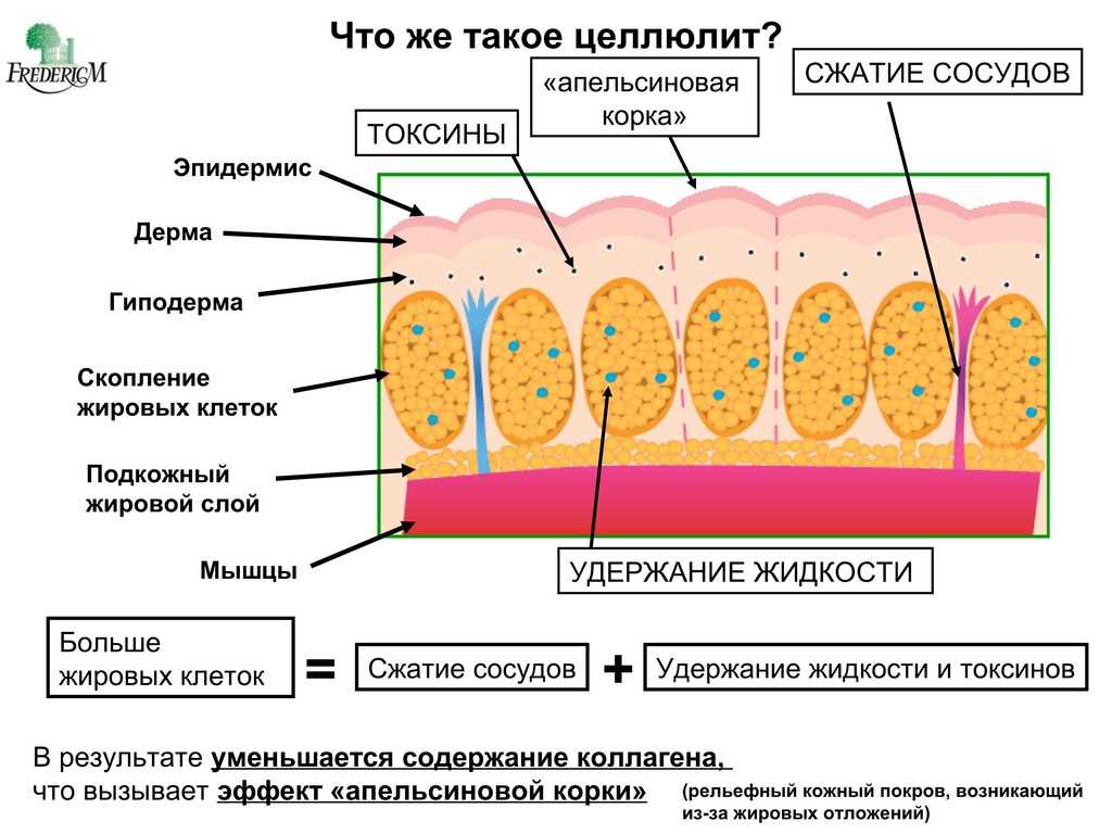 Роль эстрогенов в появлении целлюлита