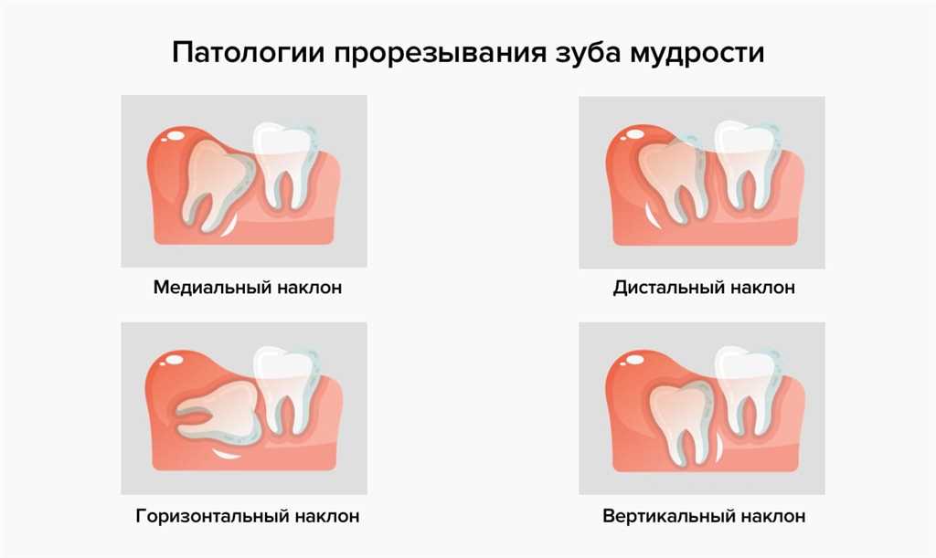 Сохранение окружающих зубов